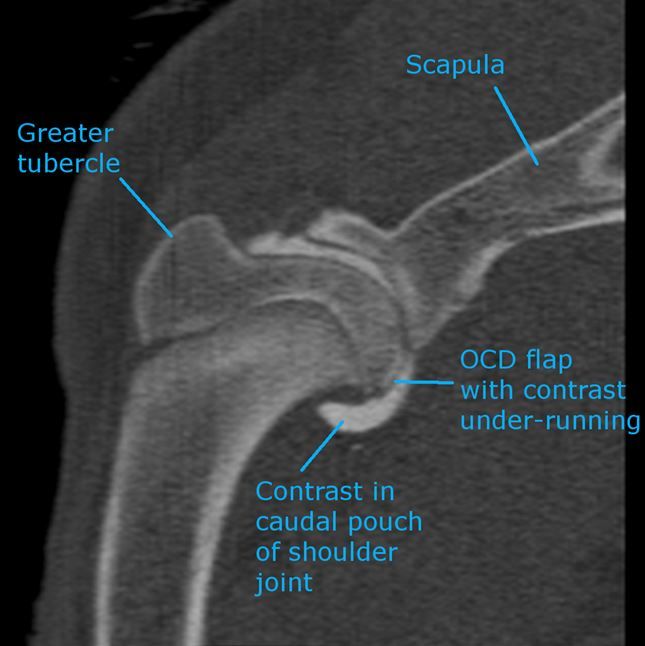 CT athrogram of shoulder